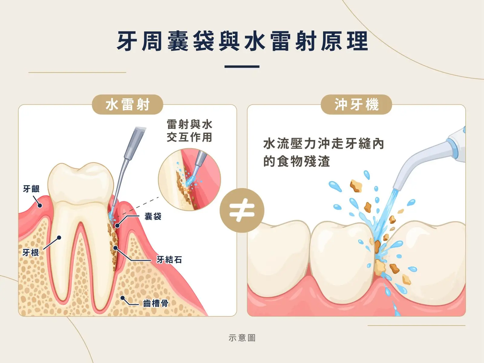 水雷射深層清創原理＆沖牙機原理示意圖。