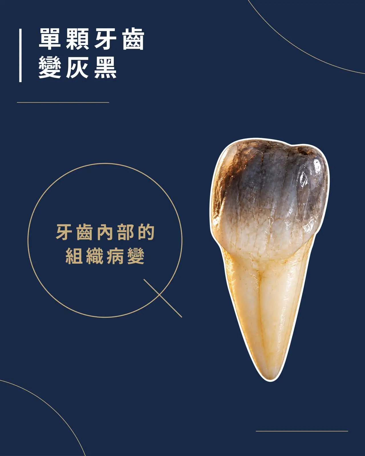 單顆牙齒變灰、變暗。